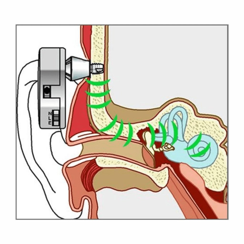 BAHA Implant Hearing Aids | Texas ENT Specialists - Baha Mar New Year's Eve 2024