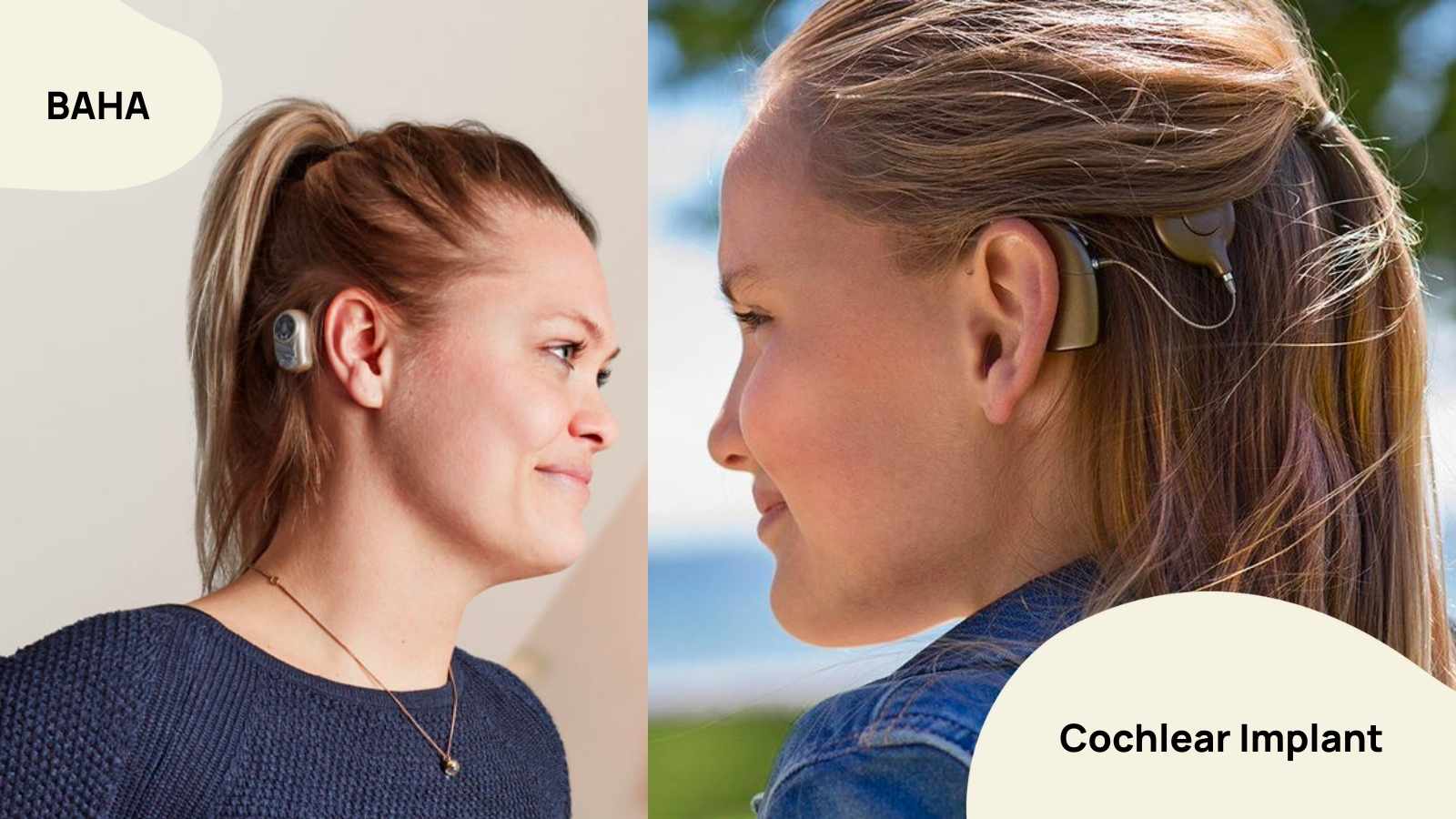 Bone Anchored Hearing Aids (BAHA) Explained - With Photos - Baha Mar New Year's Eve 2024