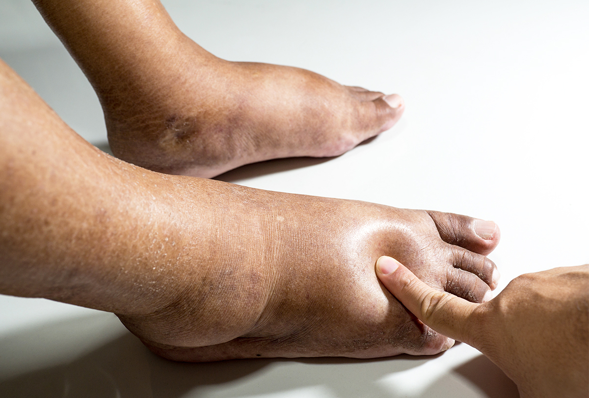 Edema Can Best Be Observed In