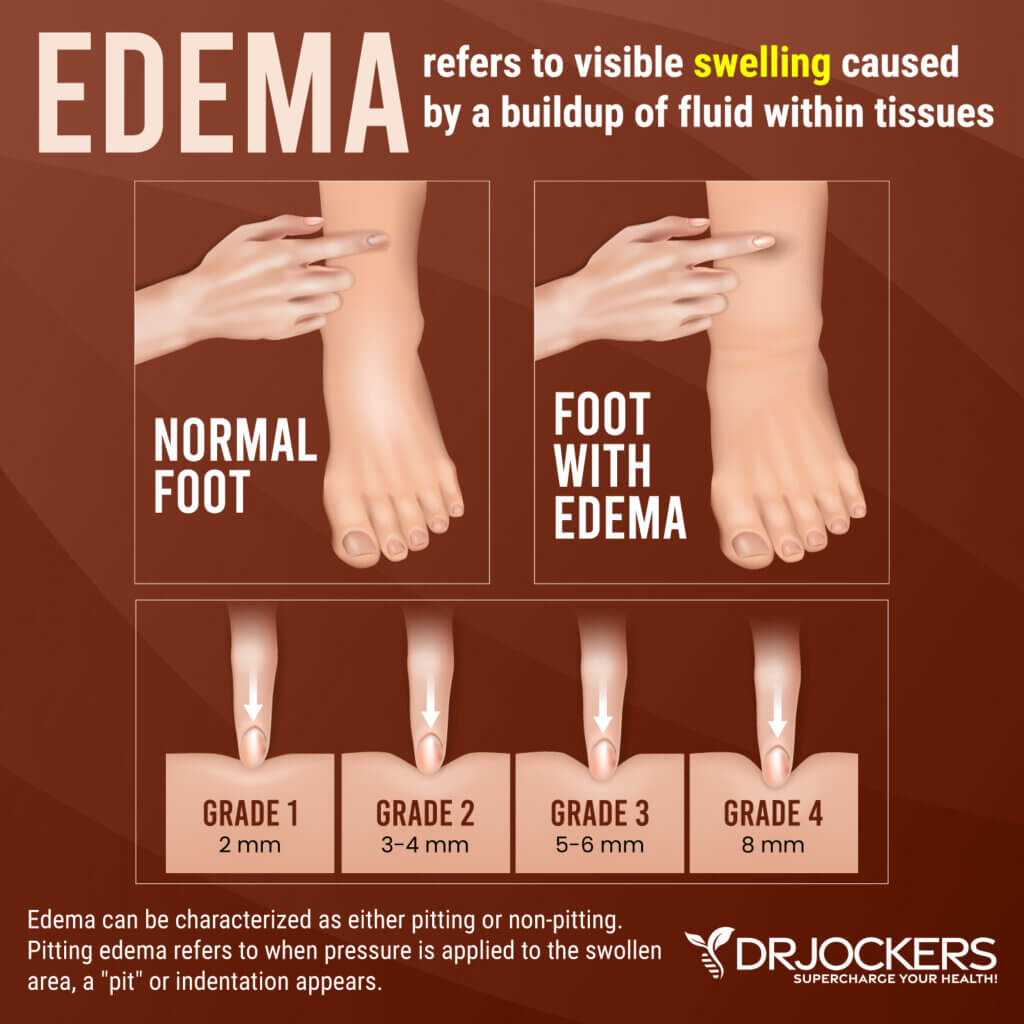 Edema: Symptoms, Causes, and Natural Support Strategies - Edema Can Best Be Observed In