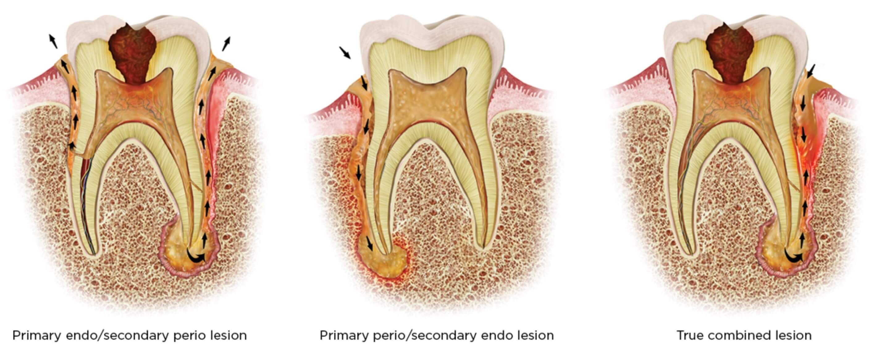 Endo-Perio Lesion | Tissue types, Endo, Periodontal disease - What Is An Endo System Did