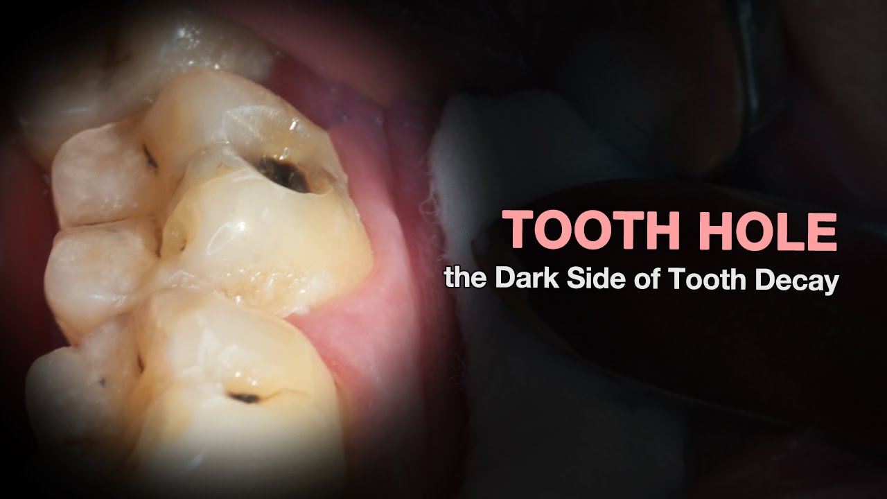 HOLE in the TOOTH? - YouTube - Words With Hole At The End