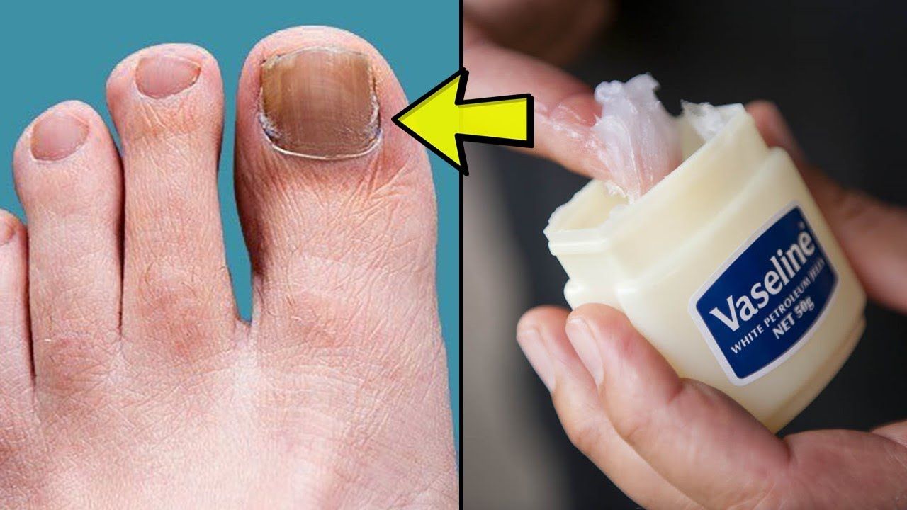 Uv Light To Kill Nail Fungus