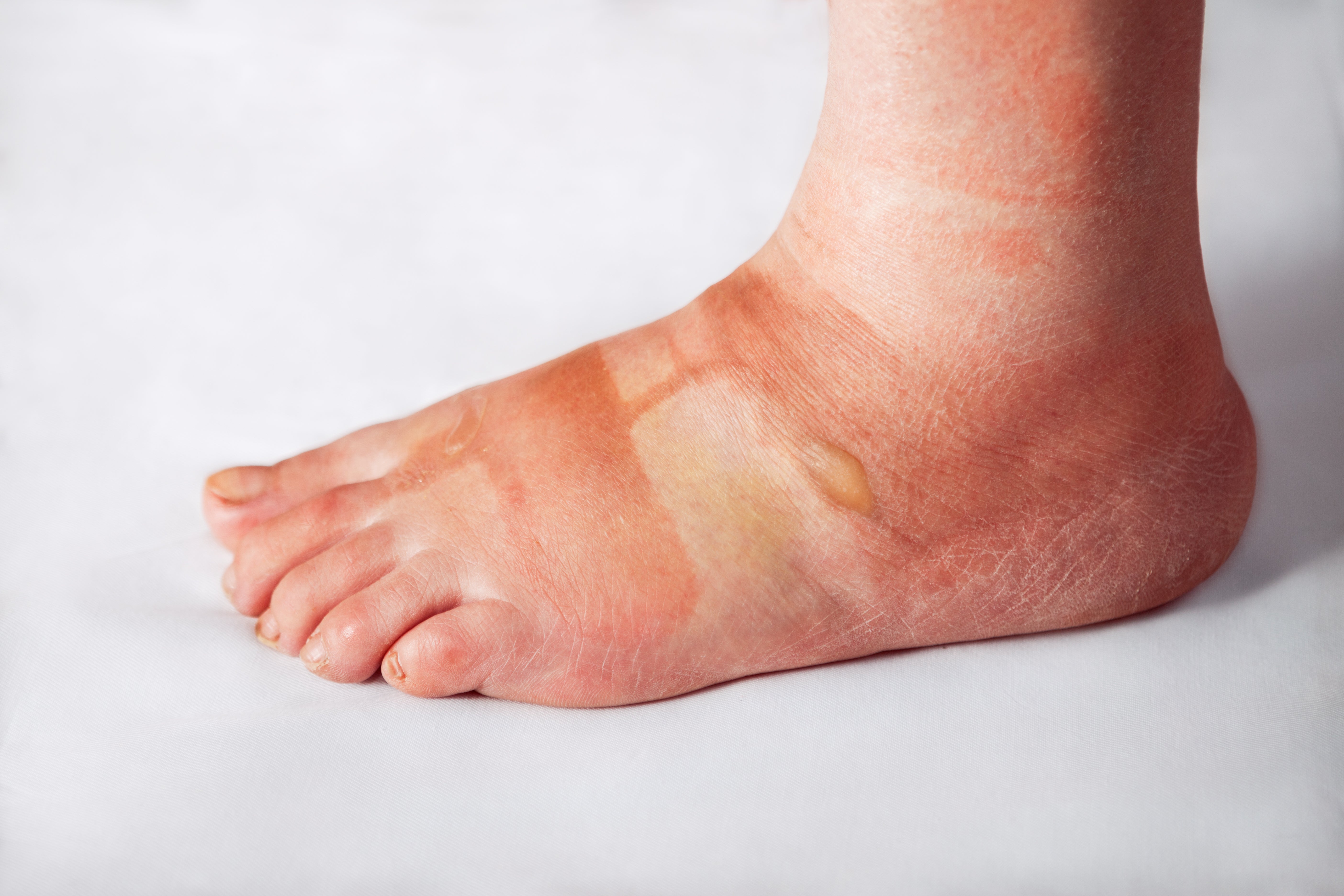 Qué es un edema | Salud180 - Edema Can Best Be Observed In