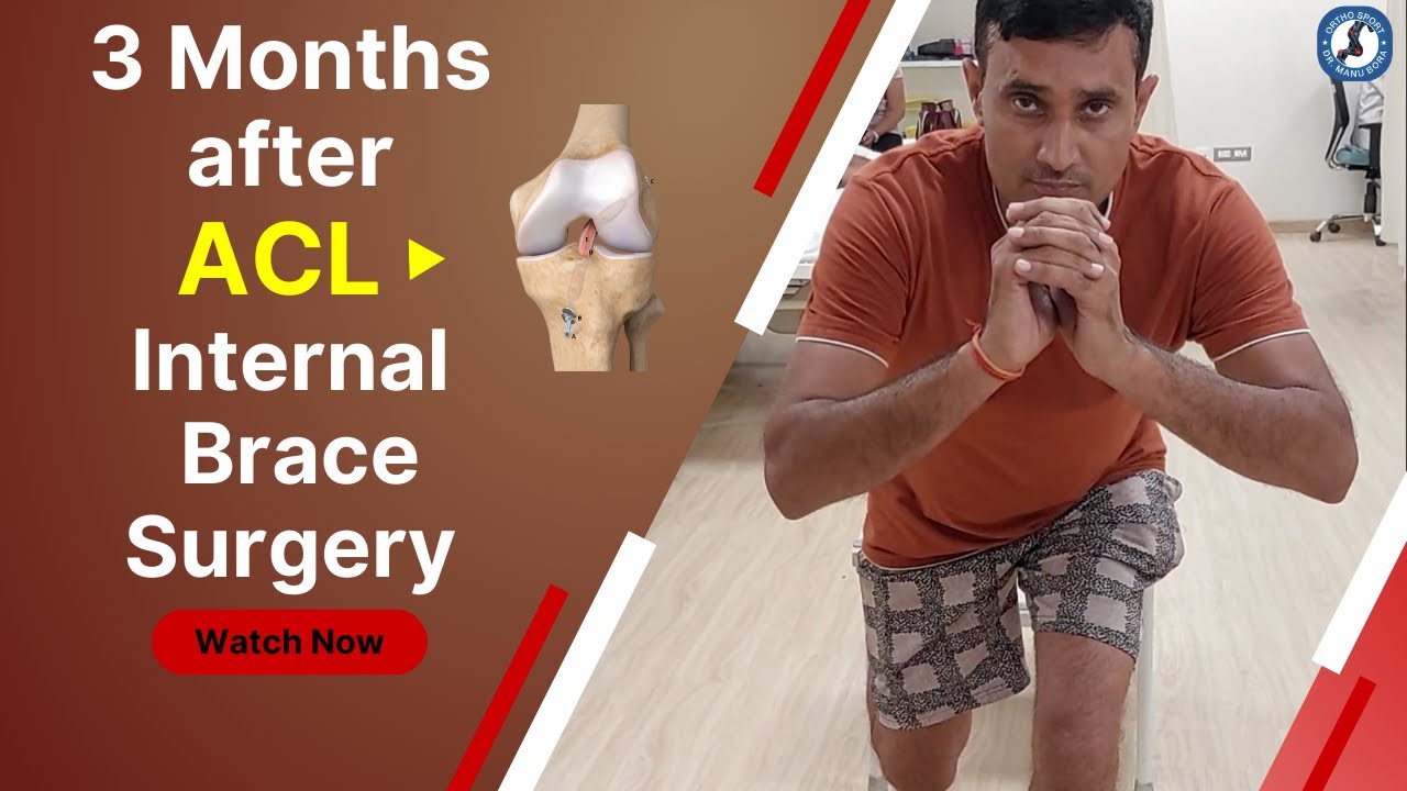 3 Months after ACL Internal Brace Surgery Recovery #aclrecovery # - When Can I Sleep Without Brace After Acl Surgery
