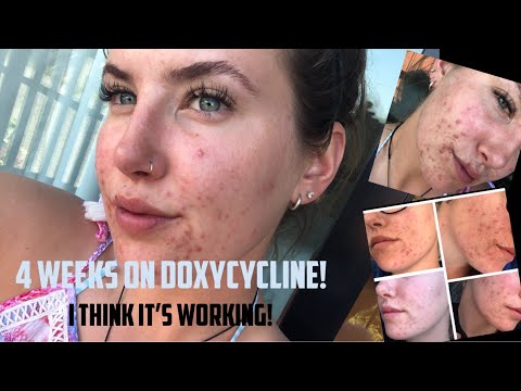 ACNE & Doxycycline - First 4 weeks - Update - YouTube - How Quickly Does Doxycycline Work For Acne