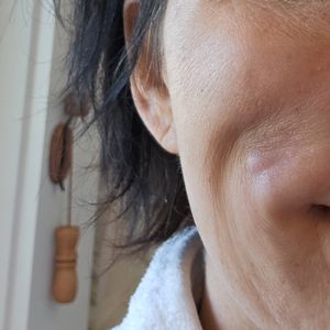 ADVANCED AESTHETIC SURGERY - THOMAS B. LINTNER MD - Updated December - Advanced Aesthetic Surgery Thomas B Lintner Md