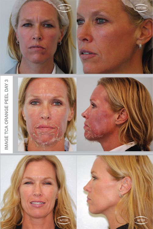 Advances In Skin & Wound Care