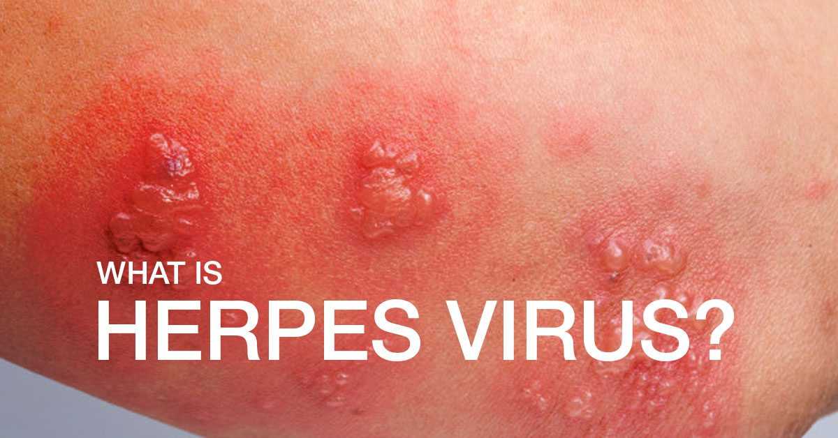 All You Need To Know About Herpes Simplex Virus | Marham - Can Herpes Cause Your White Blood Cells To Be High