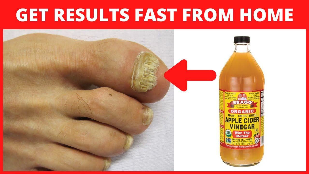 Apple Cider Vinegar for Toenail Fungus - YouTube - Toenail Fungus Apple Cider Vinegar And Baking Soda