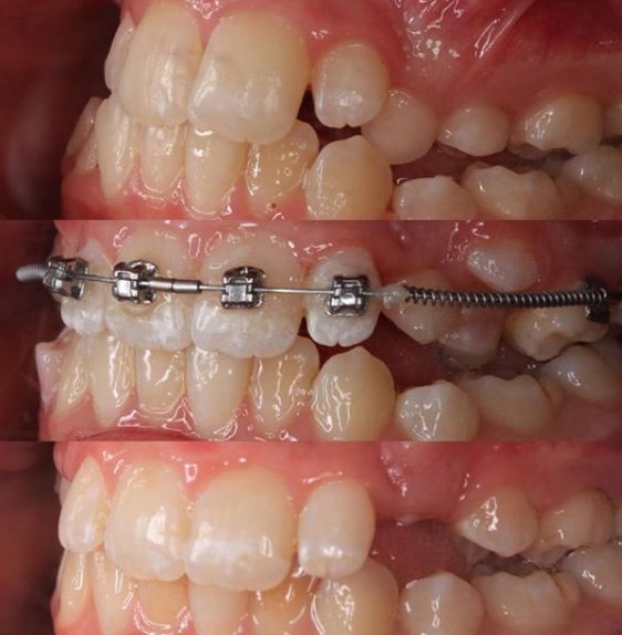 How Much Do Braces Cost In Albany
