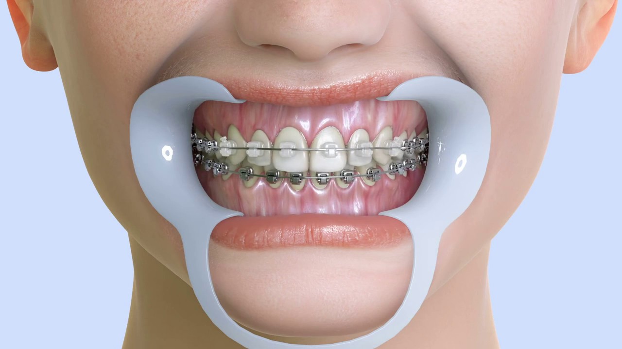 Average Cost Of Braces In Vancouver - YouTube - How Much Do Braces Cost In Albany