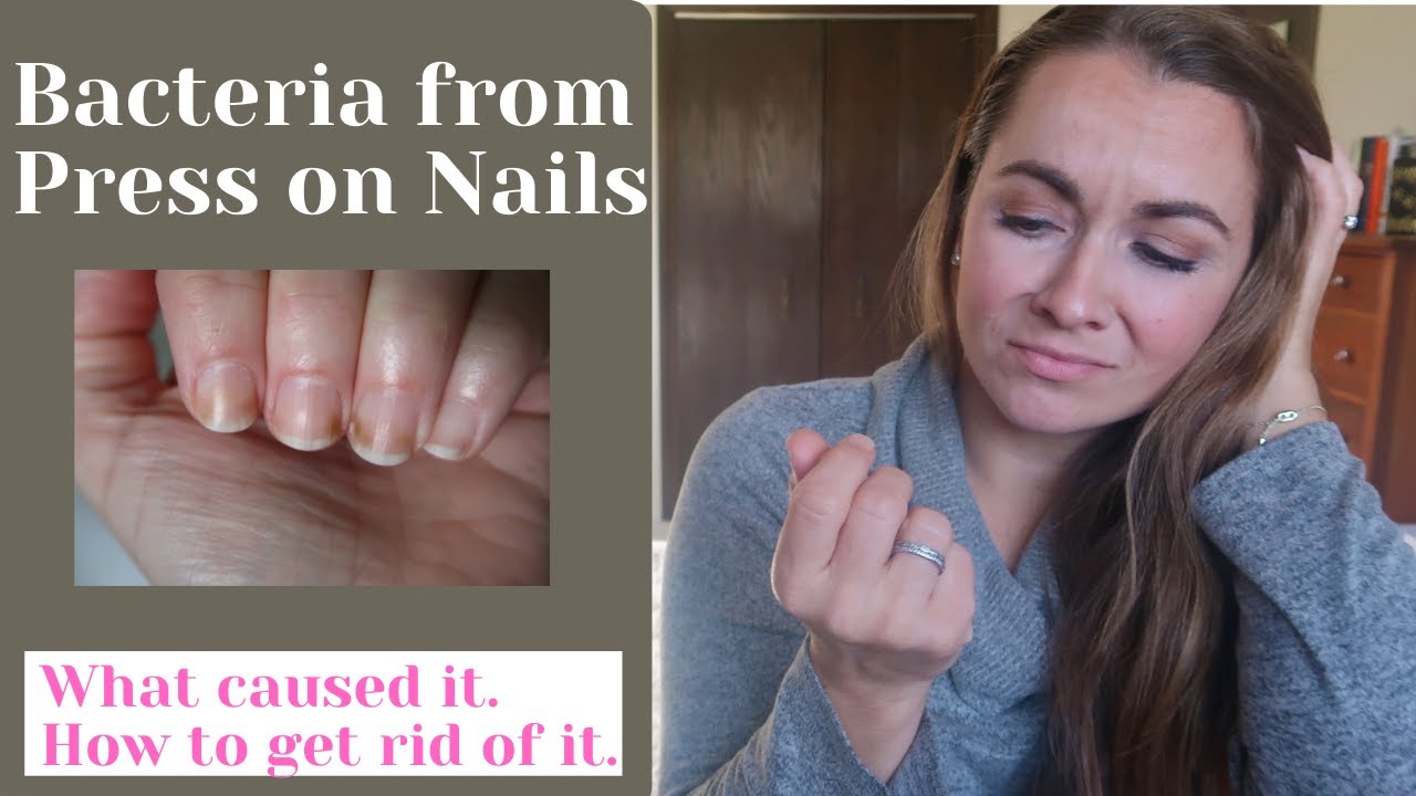 AVOID Nail Bacteria from Press on Nails | What I did | How to get rid - Nail Fungus From Press On Nails