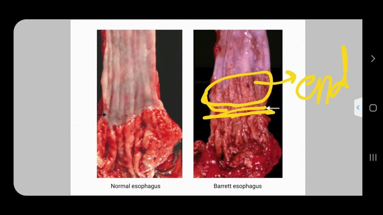 How Often Does Barrett's Esophagus Turn To Cancer
