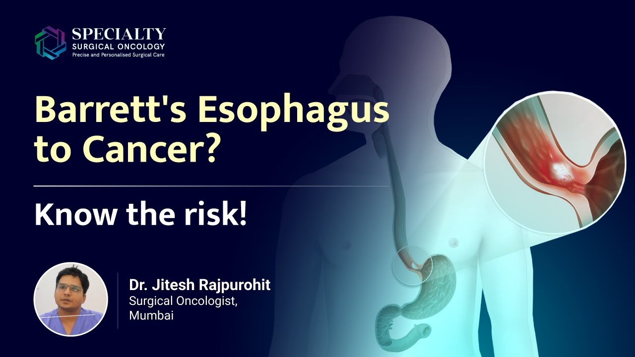Barrett's Esophagus & Cancer: Symptoms, Causes, & Management | Dr - How Often Does Barrett's Esophagus Turn To Cancer