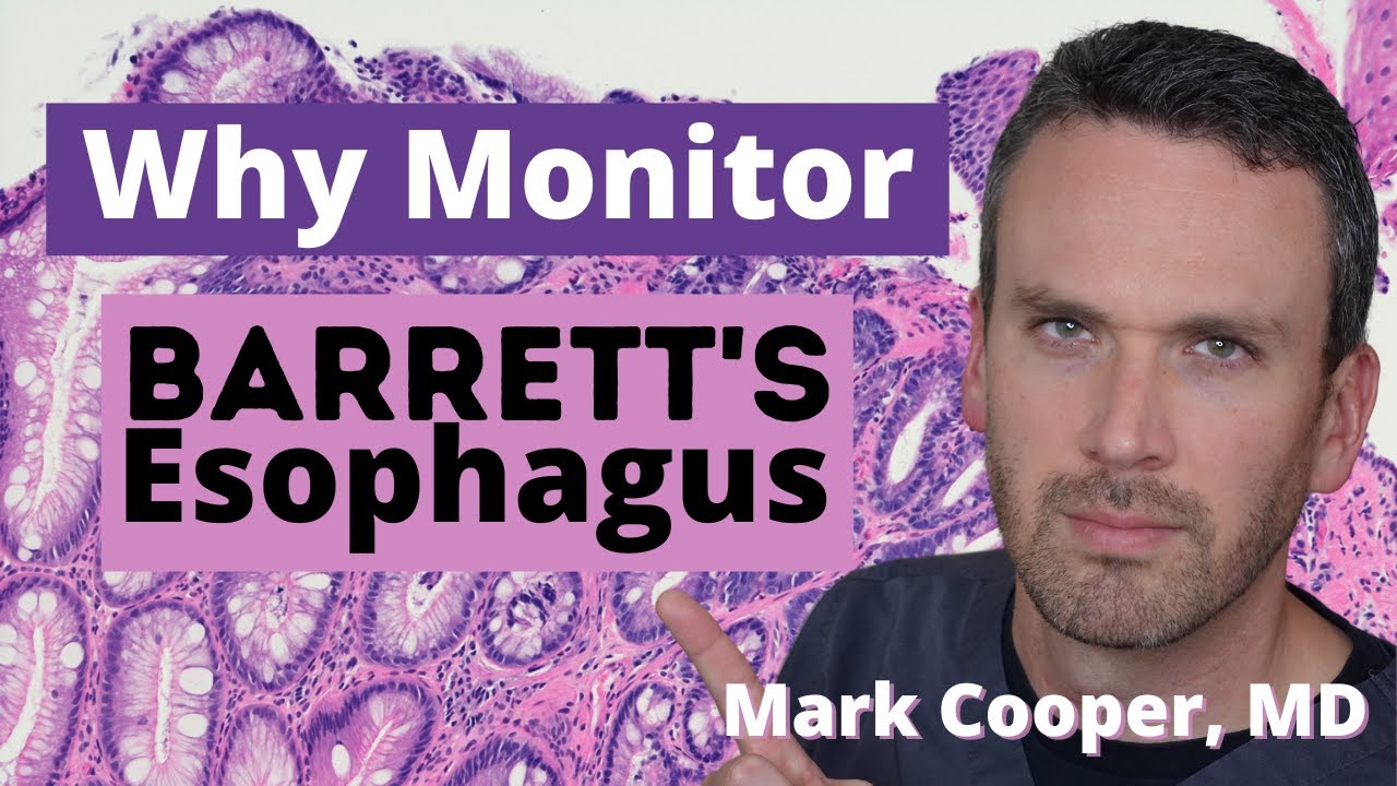 Barrett's Esophagus - Is MONITORING for Esophageal Cancer Worth the - How Often Does Barrett's Esophagus Turn To Cancer