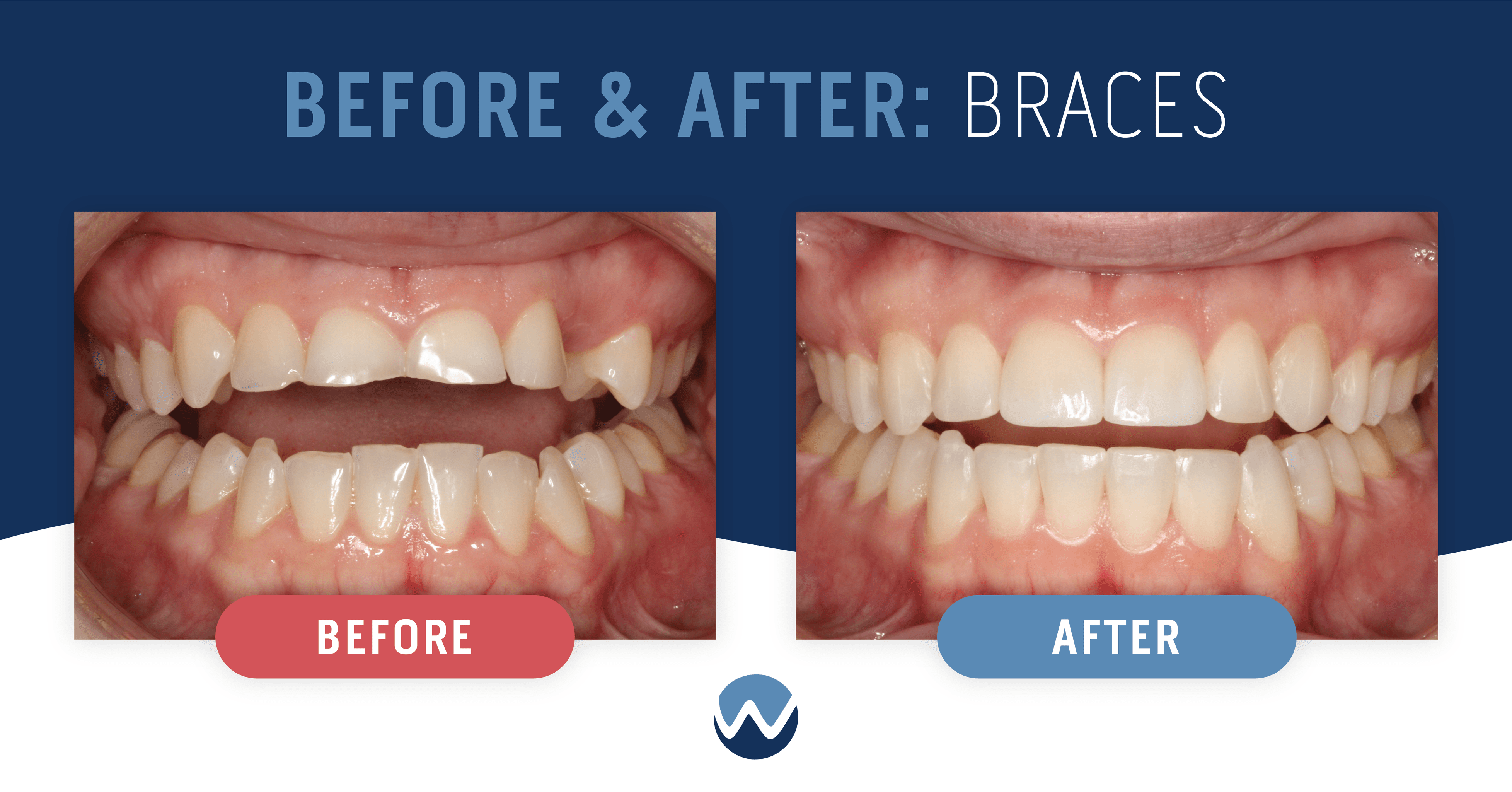 Before And After Braces Overbite - Before And After Clindamycin Phosphate Gel