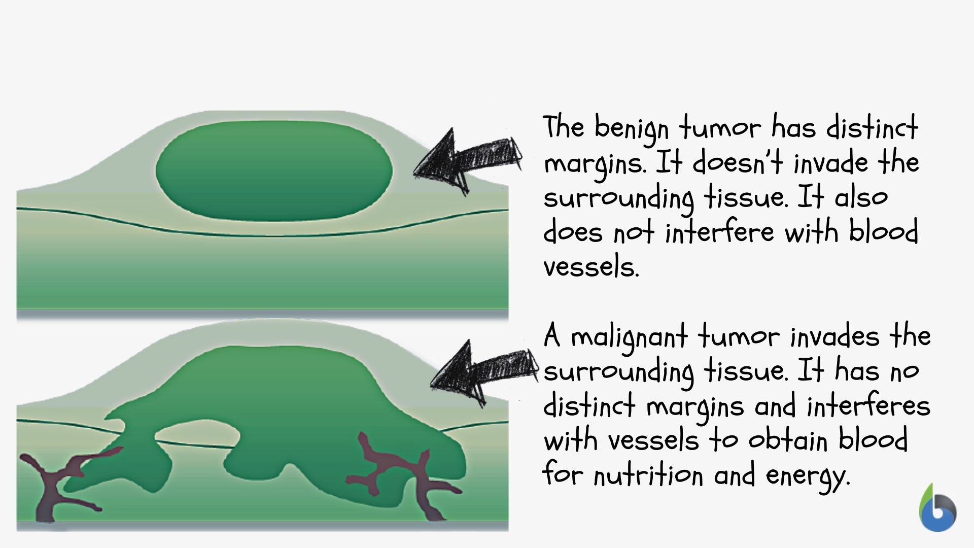 Benign - Definition and Examples - Biology Online Dictionary - Benign Prostatic Hyperplasia Vs Prostate Cancer