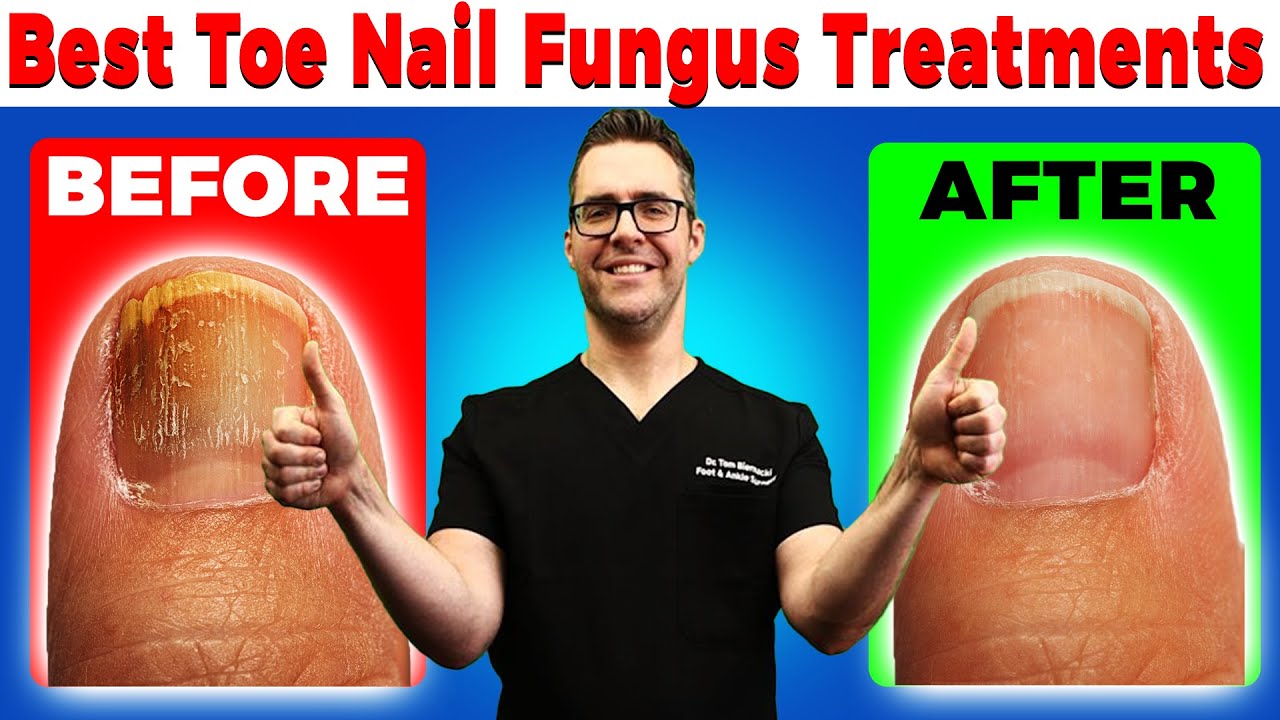 Okita Toenail Fungus Pen Reviews And Complaints
