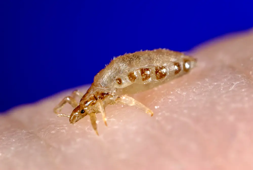 Body Lice | symptoms, diagnosis, treatment, pictures, home remedies - Lice Clinics Of America Austin Tx