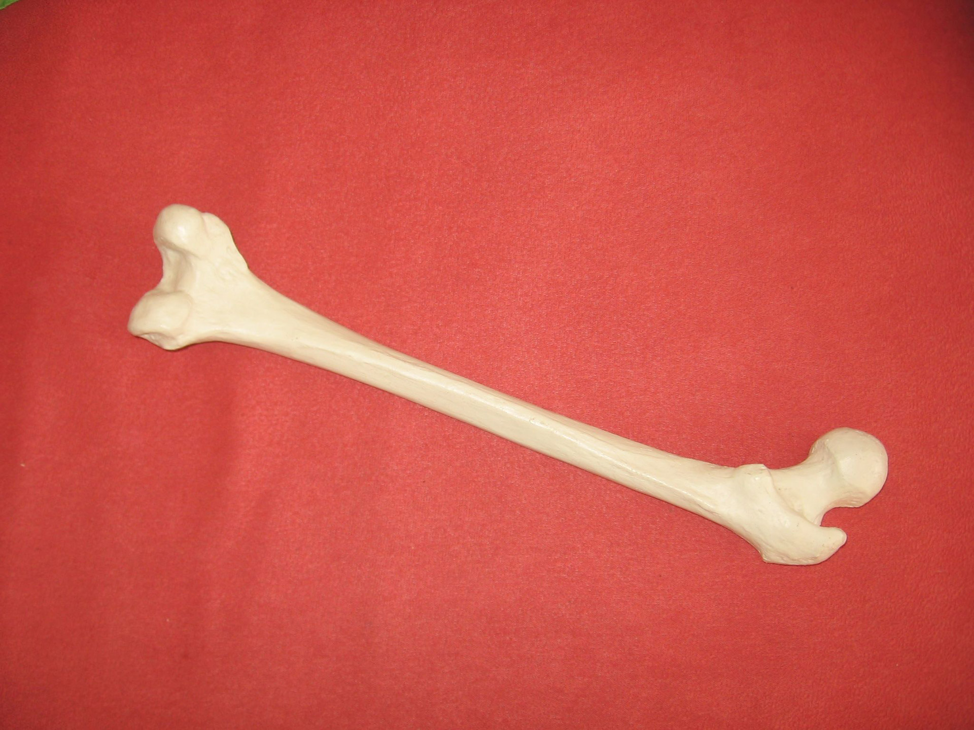 Bone Free Stock Photo - Public Domain Pictures - Bone Marrow Transplant And Sickle Cell Disease