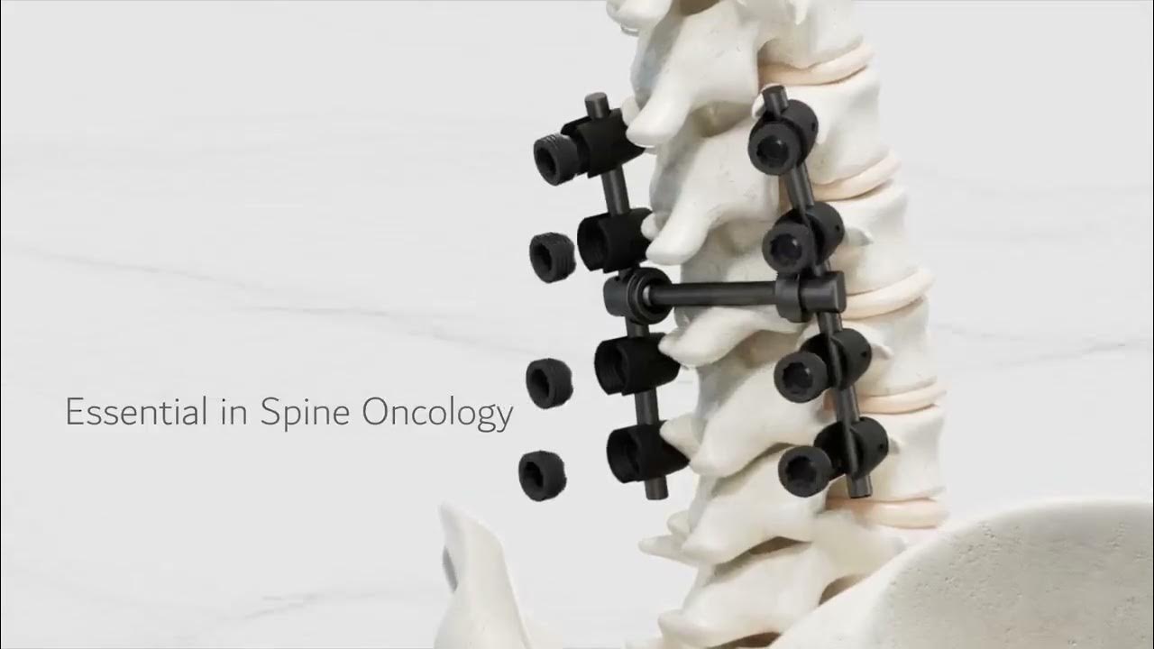 Carbofix: Carbofix Spine System - YouTube - Carbofix Orthopedics Competitive Advantages Spine Market