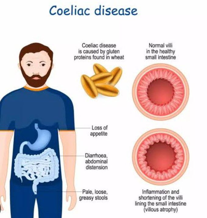 Cause of Celiac disease - MEDizzy - Celiac Disease Can Cause Unstable Blood Sugar Control.