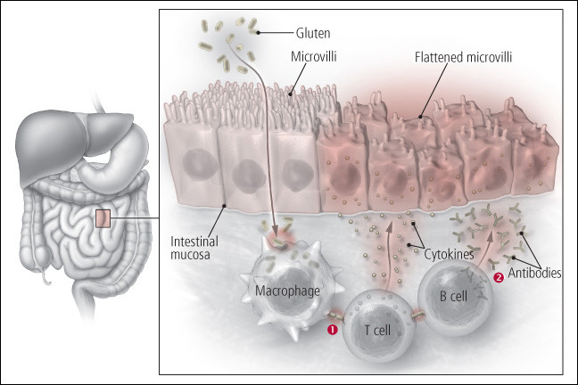 Celiac disease - Harvard Health - Celiac Disease Can Cause Unstable Blood Sugar Control.