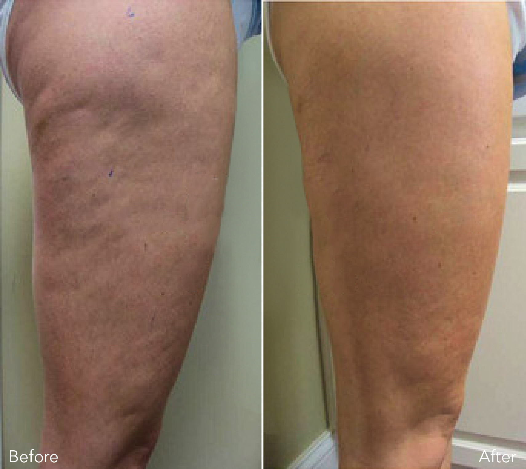 Does Cellulite Go Away When You Lose Weight