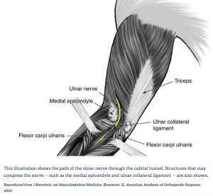 Cubital Tunnel Syndrome – Carolyn Yang, MD - Knee Brace For Lateral Knee Pain