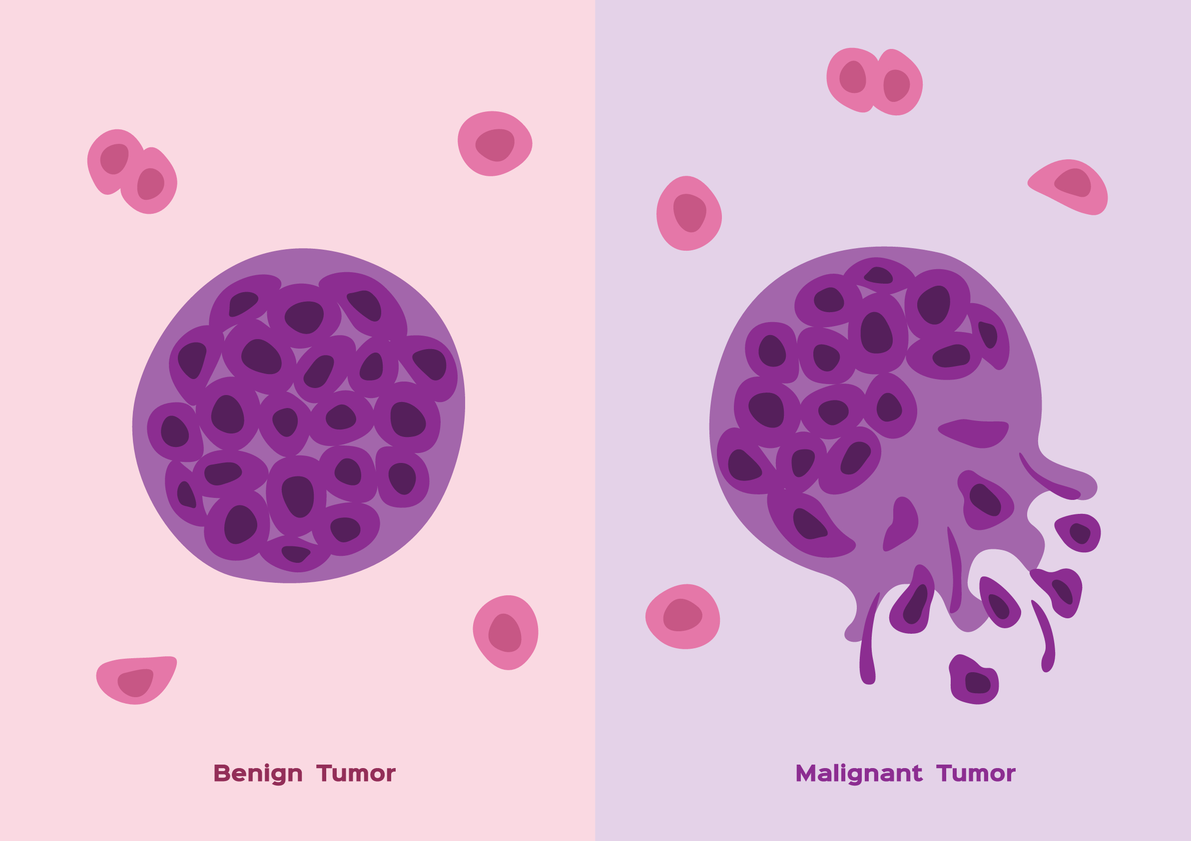 Diferenças Entre Tumor Benigno E Maligno - Benign Prostatic Hyperplasia Vs Prostate Cancer