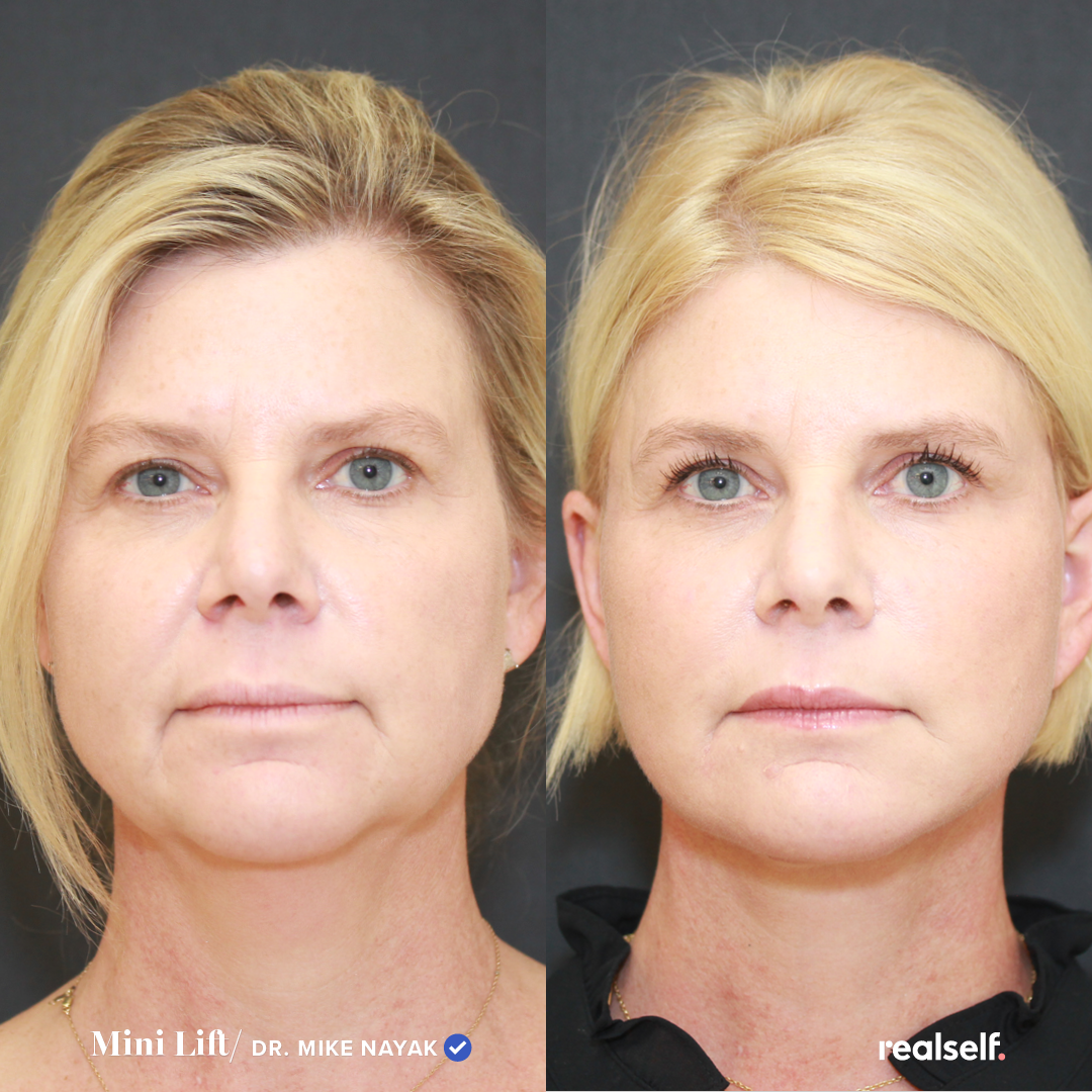 How Much Does A Mini Facelift Cost In Florida