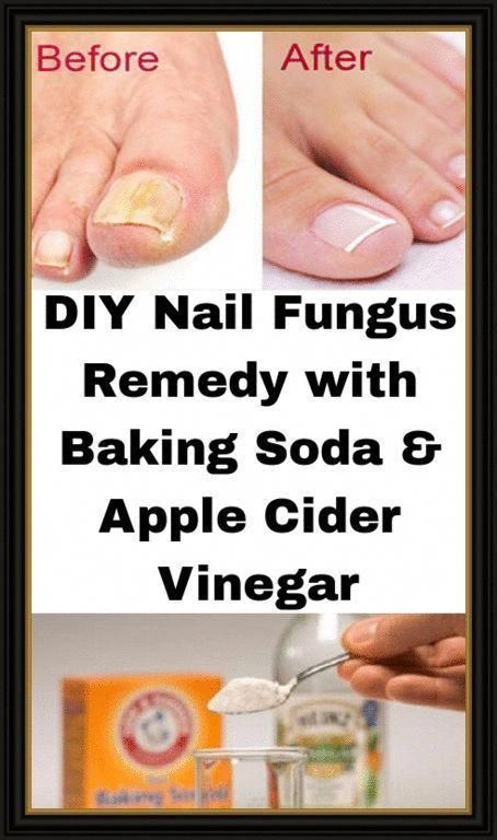 DIY Nail Fungus Remedy with Baking Soda & Apple Cider Vinegar # - Toenail Fungus Apple Cider Vinegar And Baking Soda