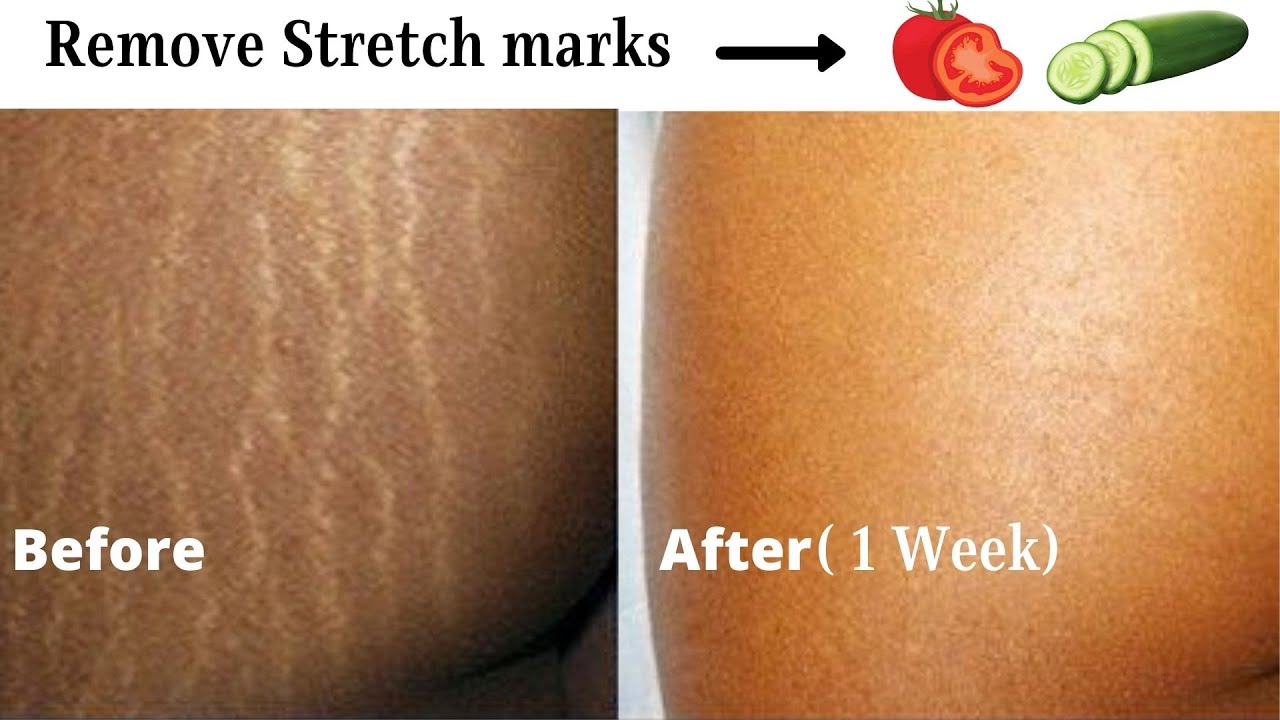 DIY STRETCH MARK REMOVAL | FADE STRETCH MARKS IN 1 WEEK - YouTube - Will Stretch Marks Go Away After Losing Weight