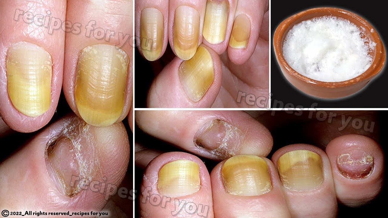 Do you suffer from nail fungus? You have to do this!!!! *** VERY - Nail Fungus From Press On Nails