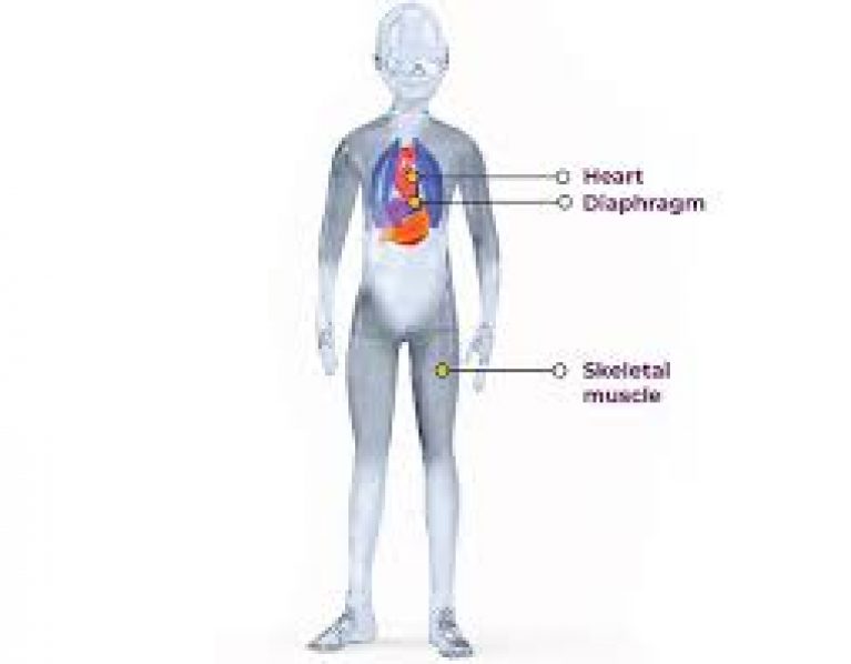 Duchenne Muscular Dystrophy - Through Which Mechanism Is Duchenne Muscular Dystrophy Acquired