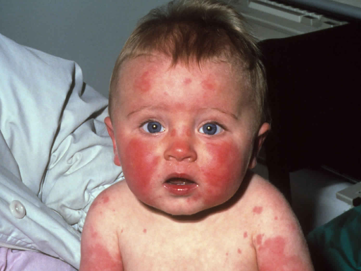 Erythema infectiosum causes, symptoms, diagnosis, treatment & prognosis - Erythema Multiforme And Stevens Johnson Syndrome