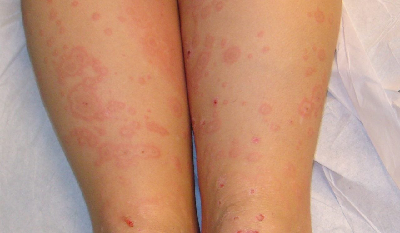 Erythema multiforme - Dermatology Advisor - Erythema Multiforme And Stevens Johnson Syndrome