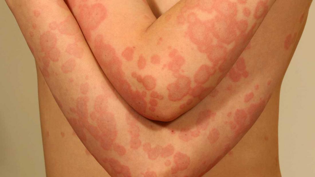 Erythema Multiforme And Stevens Johnson Syndrome