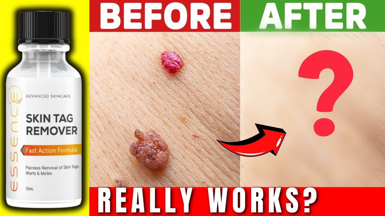 🔥 Essence Skin Tag Remover Review 🚨EXPOSED Does Essence Skin Tag - Essential Oil To Remove Skin Tag
