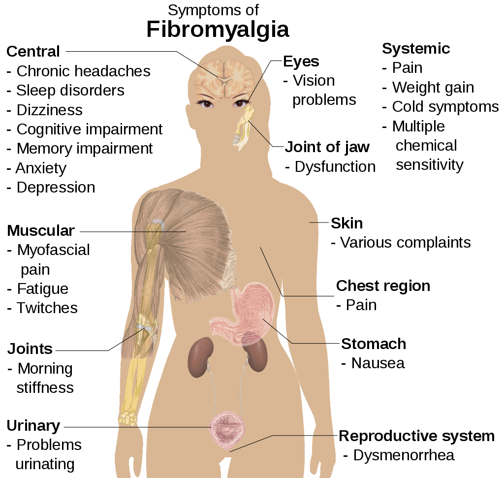 Fibromyalgia: Diagnostic Criteria and the Danger of Misdiagnosis - Can Fibromyalgia Cause Neuropathy In Feet