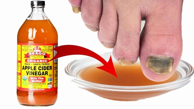 Toenail Fungus Apple Cider Vinegar And Baking Soda