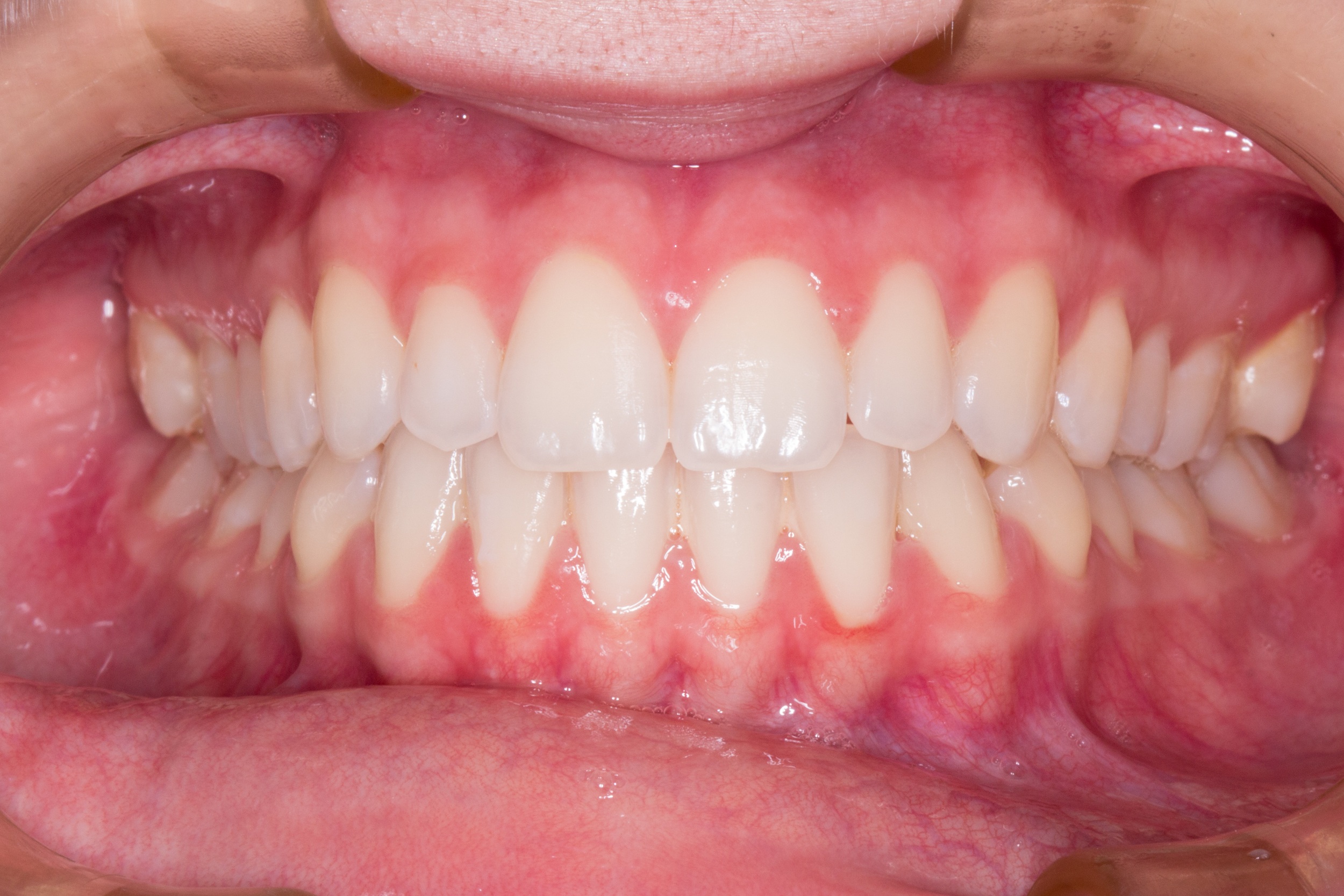 Four Different Types of Teeth and Their Function | Shervin M. Louie, DDS - Teeth Whitening Business Start Up Package