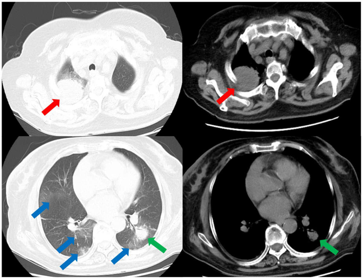 Frontiers | Multiple pulmonary cavities in an immunocompetent patient - Report Three Types Of Inventory On The Balance Sheet