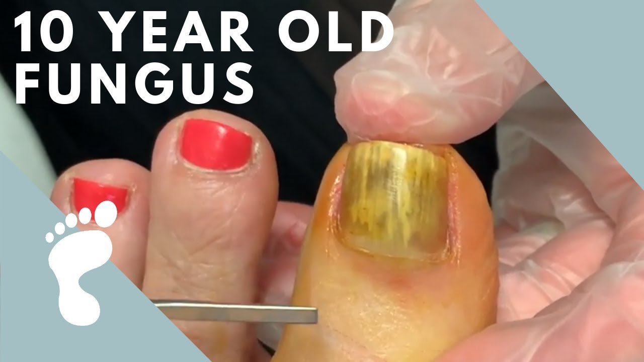 Fungus Exodus For Toenail Fungus Reviews Before And After