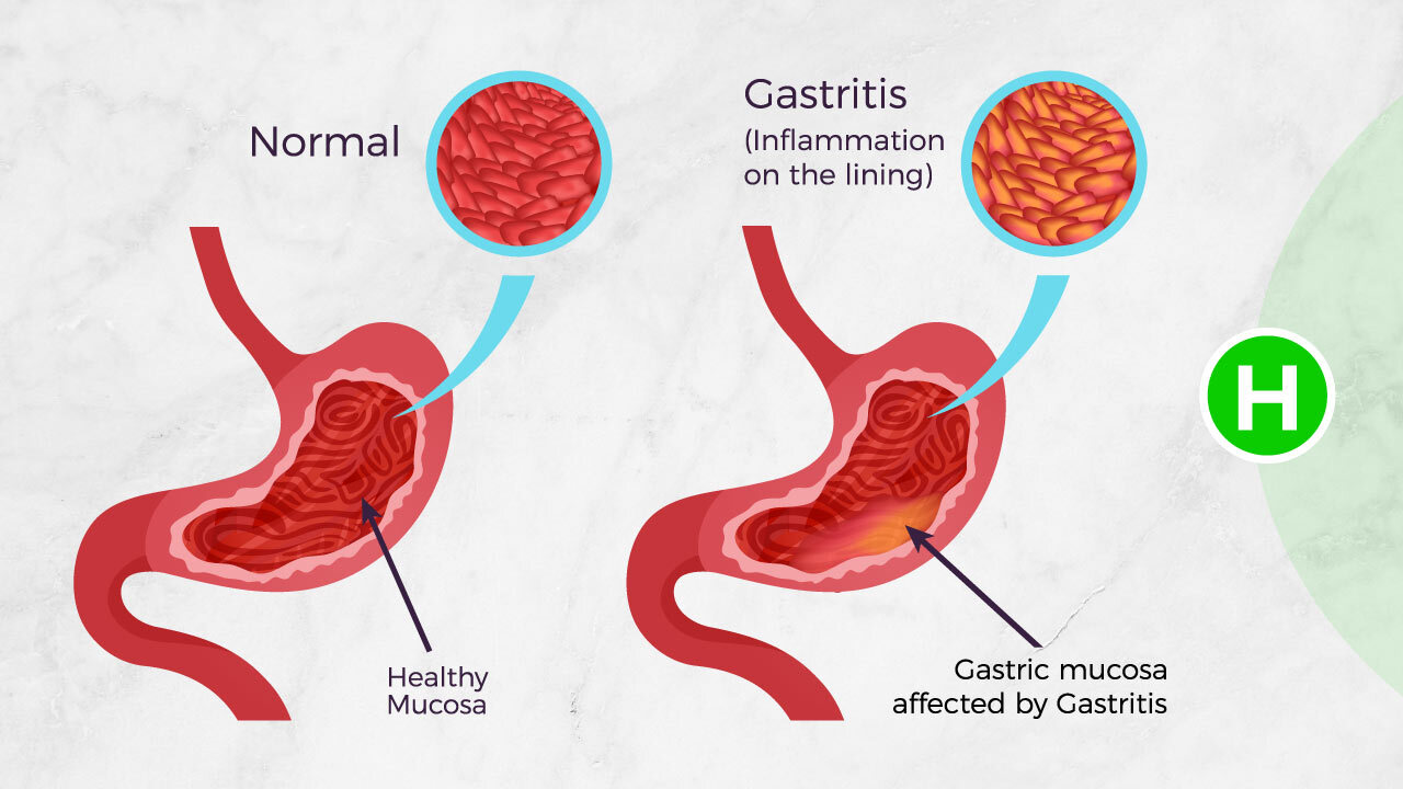 Can Gastritis Cause High White Blood Count