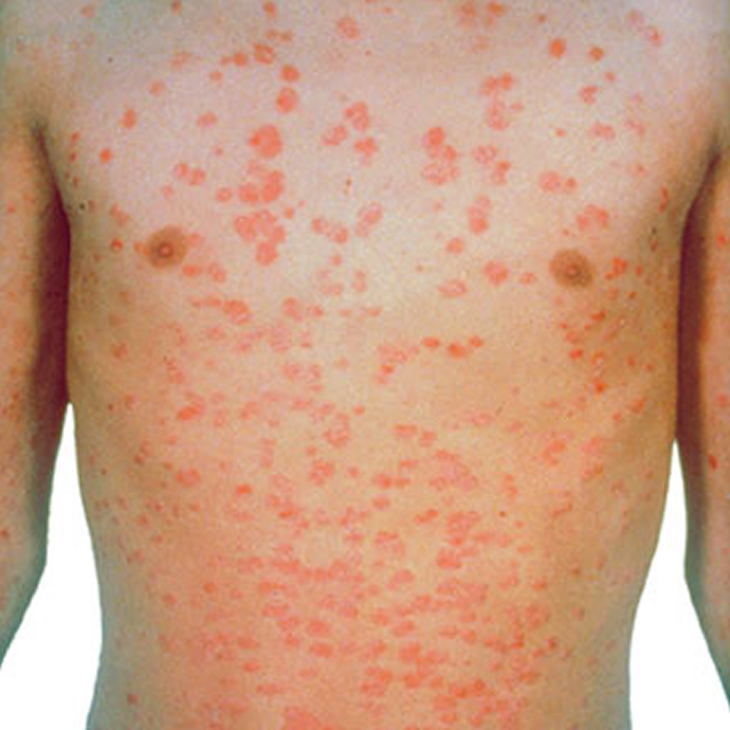 Guttate Psoriasis - Causes, Symptoms, Treatment, Diet & Home Remedy - Can Psoriasis Cause High White Blood Cell Count