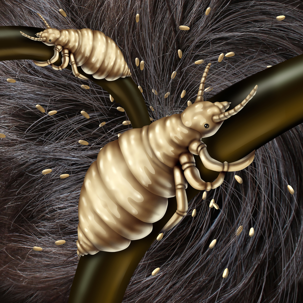 Head Lice And The Other Types - Lice Clinics of Texas - Lice Clinics Of America San Jose