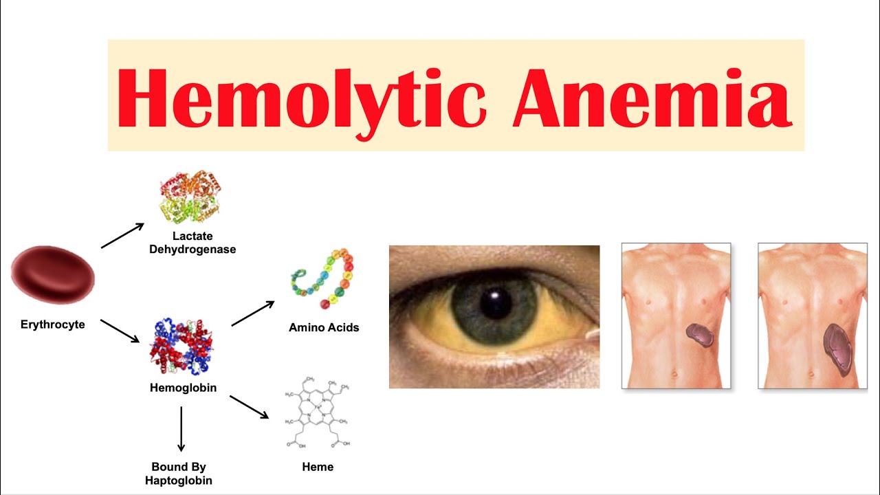 Choose All That May Cause Hemolytic Anemia.
