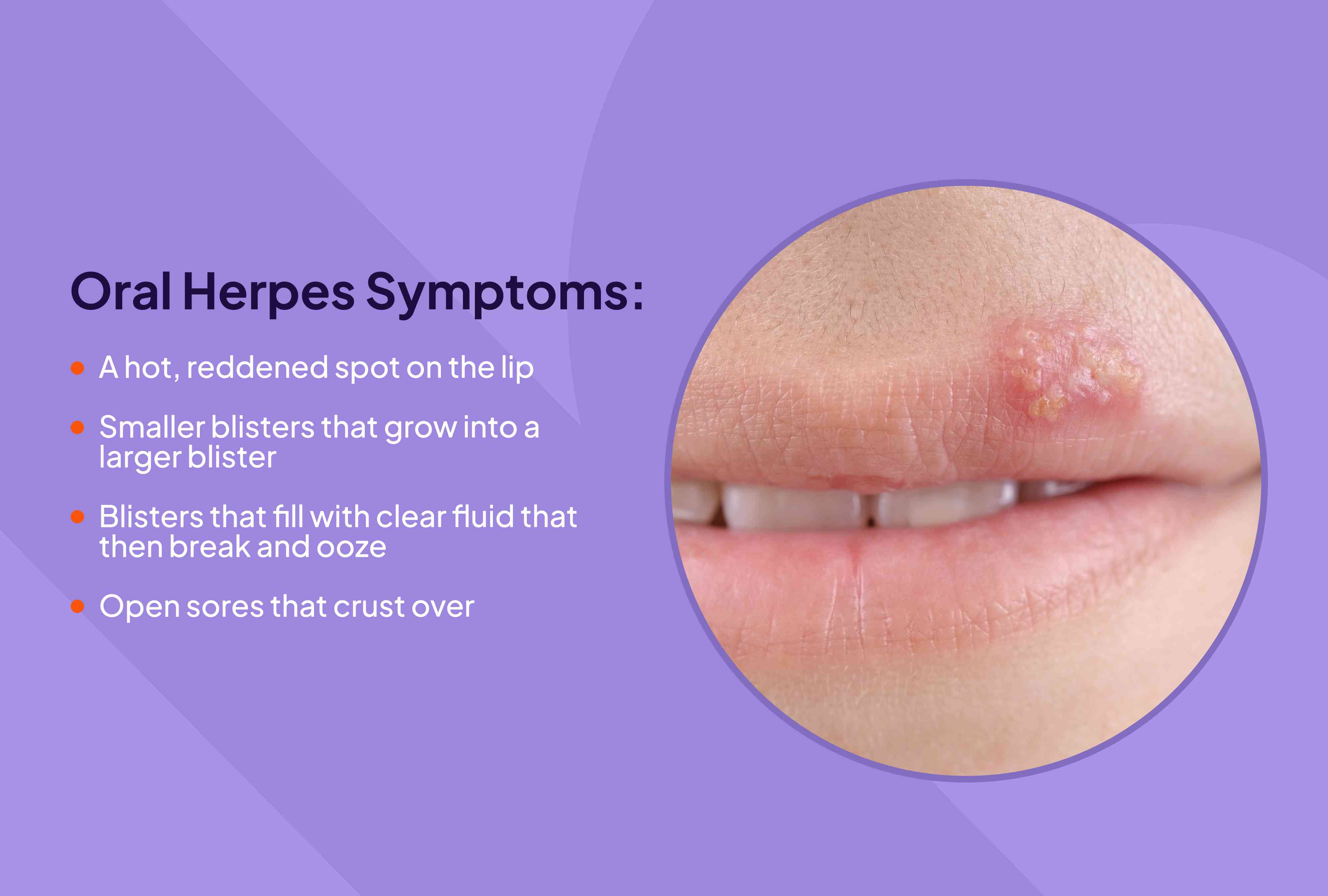 Can Herpes Cause Your White Blood Cells To Be High
